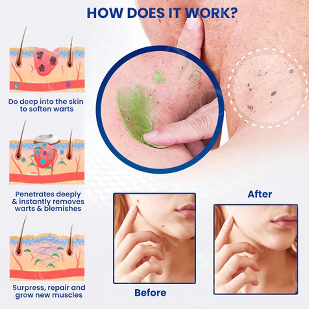 ✅ Official Store: Natravor™ NatureErase Instant Mole & Spot Cream