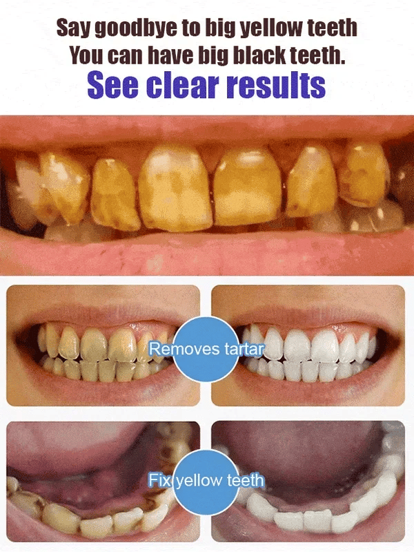 🔥Super Probiotic-6 Pasta de Dientes con 6 Probióticos equilibra la microbiota oral y fortalece