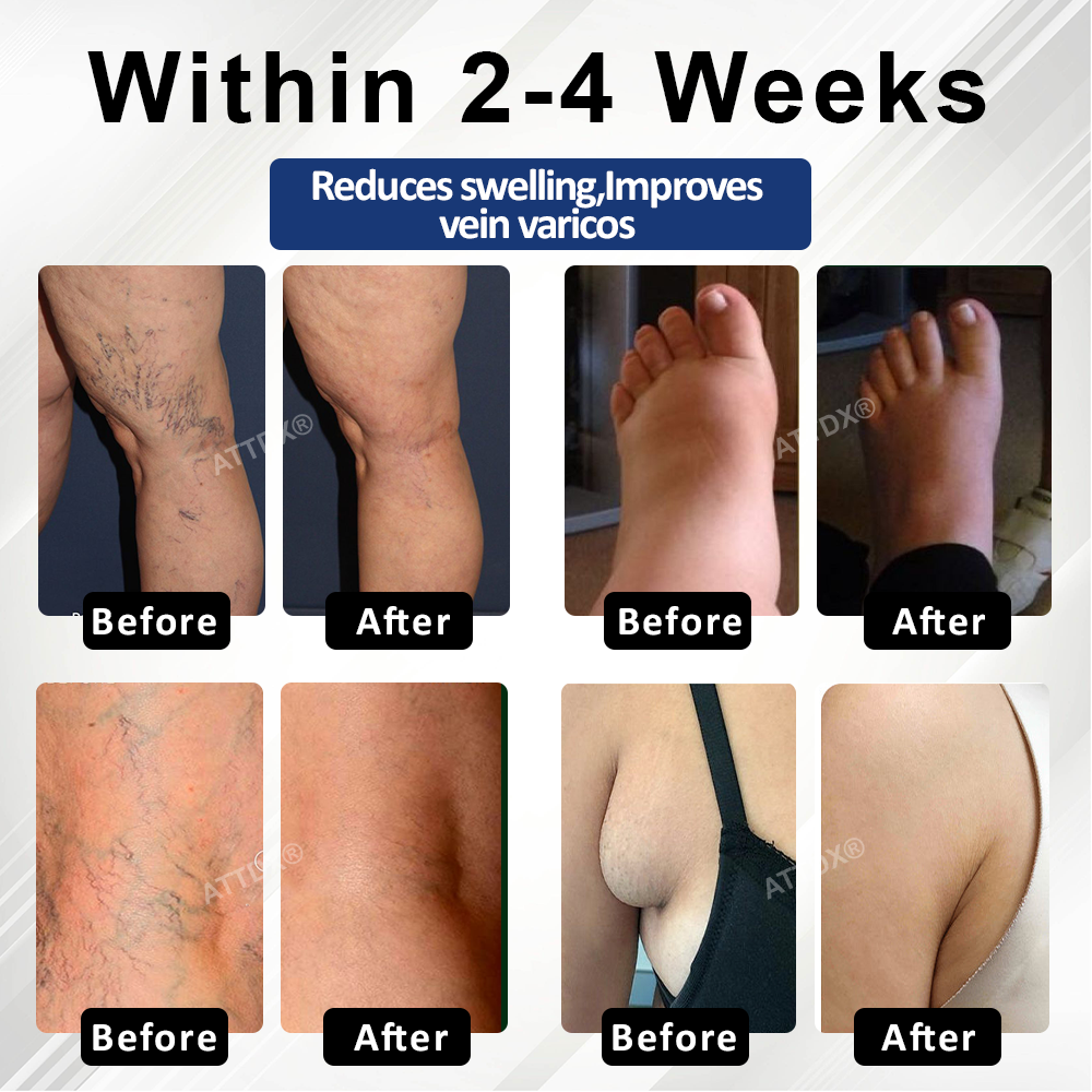 Natravor™ VenoHerb Black Cumin Edema Relief Balm