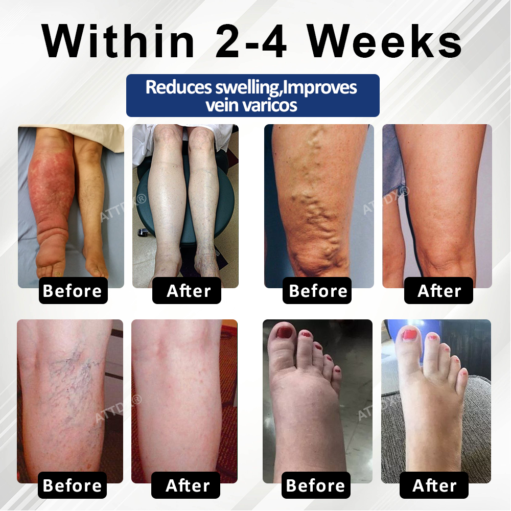 Natravor™ VenoHerb Black Cumin Edema Relief Balm
