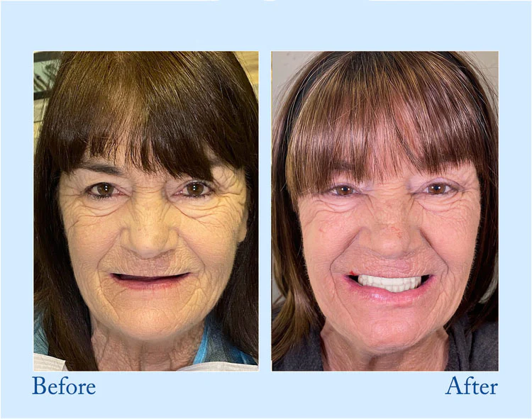 Natravor™ - Premium Denture