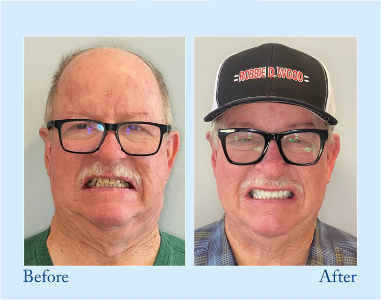 Natravor™ - Premium Denture