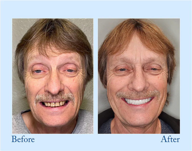 Natravor™ - Premium Denture