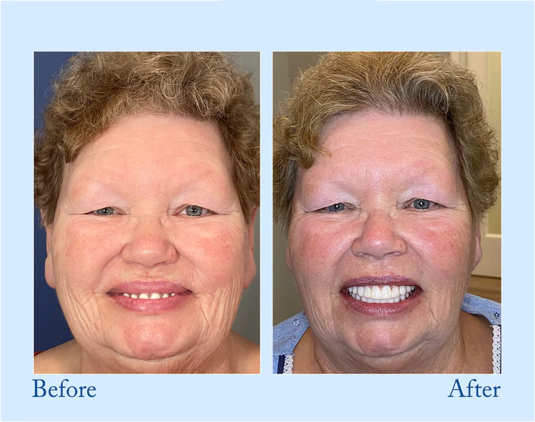 Natravor™ - Premium Denture