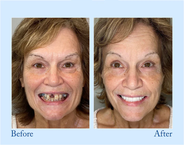 Natravor™ - Premium Denture
