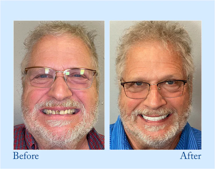 Natravor™ - Premium Denture