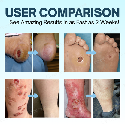 ⏰ Limited Time 50% Off! Natravor™ Diabetes Treatment Cream